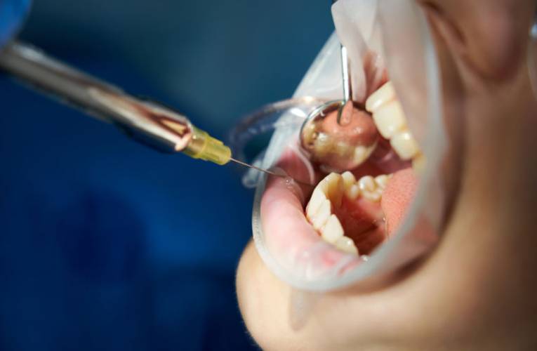 Co to jest endodoncja i kiedy się ją stosuje?