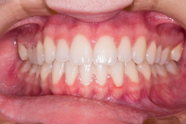 Czym różnią się klasyczne aparaty ortodontyczne od nakładek prostujących zęby?
